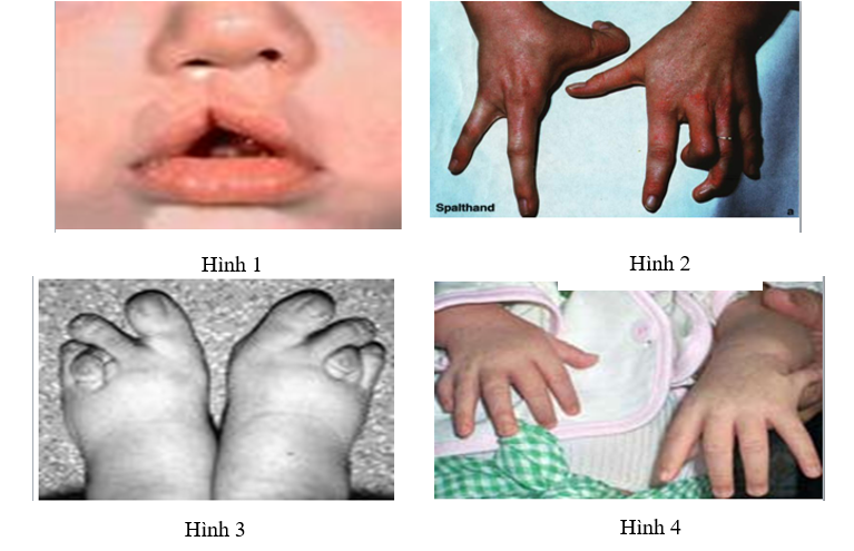 Em hãy kể tên các tật di truyền có trong các hình ảnh dưới đây: (ảnh 1)