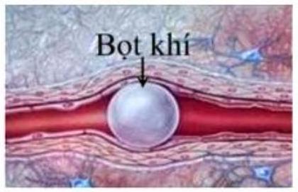 Khi cơ thể người ở môi trường áp suất tăng (như lặn xuống sâu), khí nitơ hít vào sẽ hòa tan nhiều hơn vào máu nhằm cân bằng với áp suất môi trường bên ngoài. Nếu áp suất giảm từ từ, nitơ sẽ t (ảnh 1)