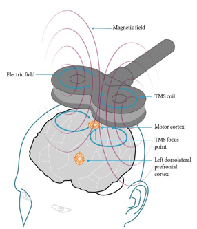 Trong lĩnh vực điều trị y học, những phát biểu nào sau đây đúng khi nói về kĩ thuật kích thích từ trường xuyên sọ TMS - Transcranial Magnetic Stimulation. Những phát biểu nào sau đây đúng?

1 (ảnh 1)