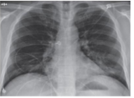 Hình ảnh ở bên là hình chụp phổi của một bệnh nhân nhiễm vi rút Covid-19. Thiết bị để chụp hình ảnh ở trên đã sử dụng tia nào sau đây (ảnh 1)