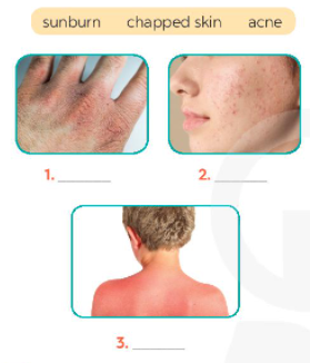 Work in pair. Discuss and write each words or phrase under the correct picture. Which skin condition  (ảnh 1)