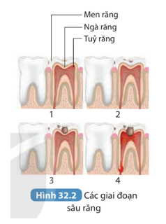 Làm việc nhóm để thực hiện các yêu cầu sau: Quan sát Hình 32.2, thảo luận về các giai đoạn hình thành lỗ sâu răng.   (ảnh 1)