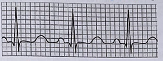 Điện tâm đồ là đồ thị ghi lại những thay đổi của dòng điện trong tim, nó được sử dụng trong y học để phát hiện ra các bệnh về tim như rối loạn nhịp tim (ảnh 1)