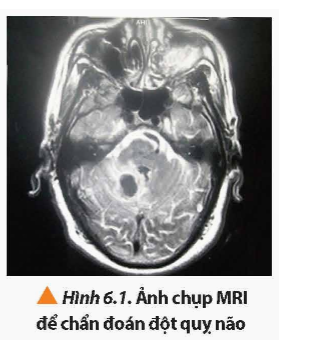 Để chẩn đoán những bất thường của não (Hình 6.1) và tuỷ sống; các bệnh liên quan đến tim mạch; bệnh liên quan đến các cơ quan nội tạng như gan, lá lách, phổi, ... bác sĩ thường tư vấn và yêu cầu bệnh nhân chụp ảnh cộng hưởng từ (MRI - Magnetic Resonance Imaging) để thu được những hình ảnh chi tiết hơn các kĩ thuật chụp ảnh khác như siêu âm, chụp ảnh cắt lớp (CT). Từ đó góp phần đáng kể giúp quá trình chẩn đoán của bác sĩ được chính xác hơn. Vậy kĩ thuật chụp cộng hưởng từ là gì và hoạt động dựa trên những cơ sở vật lí nào?   (ảnh 1)