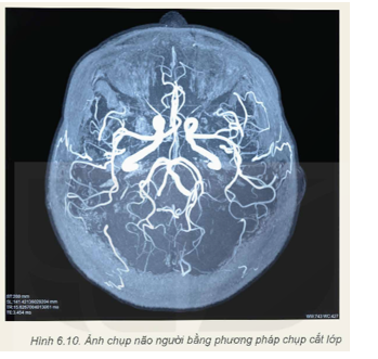 1. Giải thích lí do tại sao bệnh nhân có thể được yêu cầu nín thở trong khi chụp cắt lớp. 2. Giải thích lí do tại sao khi chụp não thì chụp cắt lớp lại thích hợp hơn X-quang (Hình 6.10).   (ảnh 1)