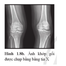 Giải thích vì sao có vùng màu sẵm, vùng màu sáng ở ảnh chụp khớp gối bằng tia X trong Hình 1.8b.   (ảnh 1)