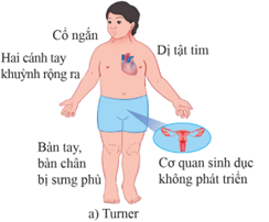 Người bị hội chứng Turner có biểu hiện  A. người bệnh là nam có cổ ngắn, lùn, mất trí nhớ.  B. người bệnh là nữ có mắt xếch, lưỡi dày, dài thè ra ngoài. (ảnh 1)