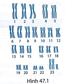 Bộ NST trong Hình 47.1 có thể là bộ NST của người mắc bệnh, tật di truyền nào?  (ảnh 1)