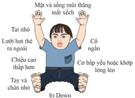 Người bị hội chứng Down có biểu hiện  A. si đần bẩm sinh và không có con.  B. da và tóc có màu trắng, mống mắt màu hồng. (ảnh 1)