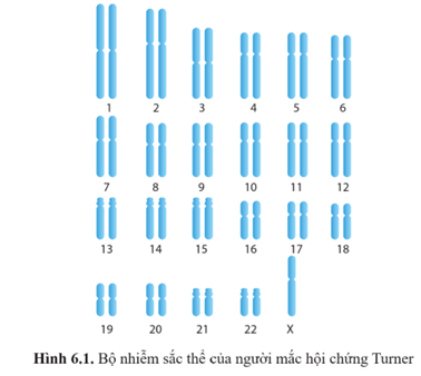 Quan sát hình 6.1 và cho biết bộ nhiễm sắc thể của người mắc hội chứng Turner khác của người bình thường như thế nào. Hãy dự đoán nguyên nhân tạo ra sự khác biệt này. (ảnh 1)