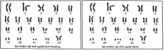 Hình dưới đây mô tả bộ NST của người bình thường và người bị bệnh. Phát biểu nào dưới đây đúng? (ảnh 1)
