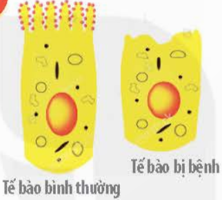 Hình dưới đây cho thấy màng tế bào niêm mạc ruột non bình thường có diện tích lớn hơn nhiều so với màng tế bào của tế bào niêm mạc ruột bất thường bên cạnh. (ảnh 1)
