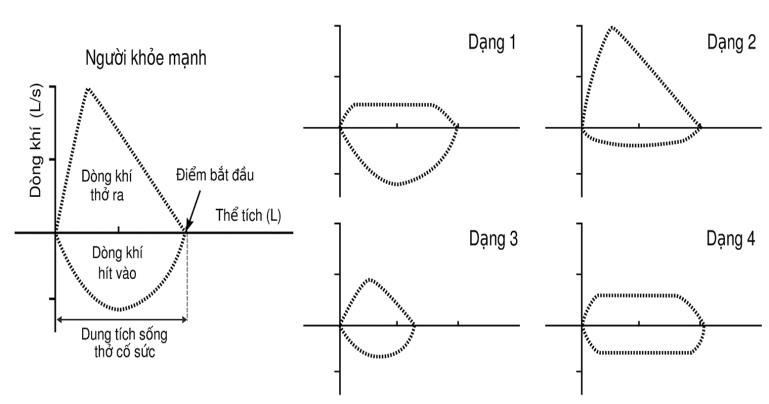 Hình 7 cho thấy dạng của vòng lưu lượng-thể tích phổi đo được khi hít vào cố sức và thở ra cố sức ở người khỏe mạnh với chức năng hô hấp bình thường và bốn bệnh nhân bị các rối loạn hô hấp thường gặp. (ảnh 1)