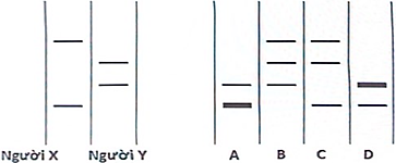 Kỹ thuật RFLP (Restriction Fragment Length Polymorphism) sử dụng các mẫu dò trên nhiễm sắc thể số 21 để tạo ra các vạch đặc trưng cho từng allele (biến thể gen) của bố, mẹ và con. Một cặp vợ chồng (X và Y) có một người con mắc hội chứng Down (ảnh 1)