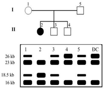 Phả hệ ở Hình 5 mô tả một gia đình có một người (người kí hiệu số 2) bị mắc chứng lùn bẩm sinh do giảm hàm lượng hormone tăng trưởng.  (ảnh 1)
