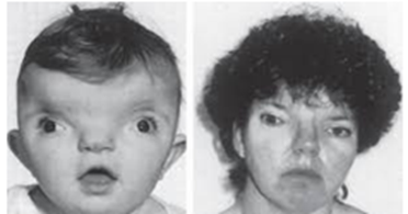 Hội chứng CFNS (Craniofrontonasal syndrome) là một dạng dị tật bẩm sinh ở người với phần đầu, mặt và mũi của người bệnh có hình dạng không bình thường như hình bên (ảnh 1)