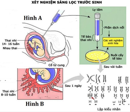Hình bên dưới mô tả về các biện pháp sàng lọc trước sinh ở người. Xét các phát biểu sau đây là đúng hay sai? (ảnh 1)
