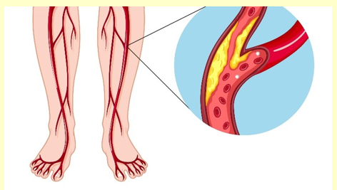 Tại sao người bị bệnh xơ vữa động mạch được khuyến khích nên sử dụng dầu thực vật? (ảnh 1)