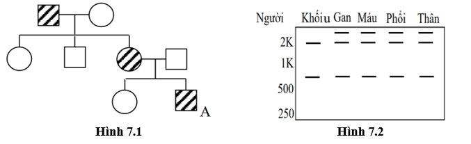 Cá thể A trong phả hệ ở hình 7.1 đã được chuẩn đoán mắc bệnh đa polyp tuyến - một dạng ung thư đại tràng có tính di truyền. Trong phả hệ này, hình tròn/vuông được gạch sọc chỉ những người mắc đa polyp. (ảnh 1)