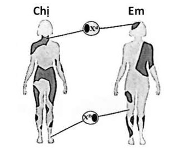 : Ở người, allele kiểu dại (D) quy định tiết mồ hôi bình thường; allele đột biến (d) ngăn cản tiết mồ hôi; gene này nằm trên NST giới tính X. (ảnh 1)