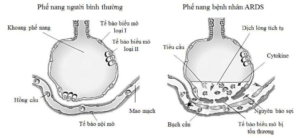 Virus nCoV là loại virus corona mới đang gây đại dịch toàn cầu. Một trong những triệu chứng trong giai đoạn diễn tiến nặng của nhiều bệnh nhân nhiễm virus này  (ảnh 1)