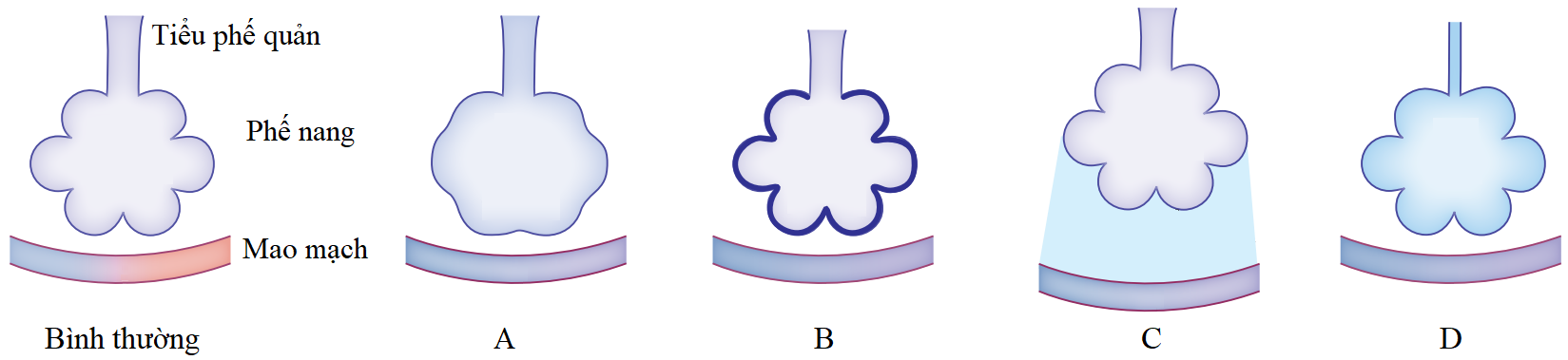 Hình 4 minh hoạ cấu trúc phế nang ở người bình thường và ở một số bệnh phổi thường gặp (A, B, C, D). a. Hãy cho biết mỗi mô tả dưới đây phù hợp với bệnh nào trong các bệnh trên? Giải thích. (ảnh 1)