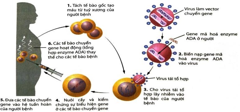 Trong điều trị bệnh rối loạn suy giảm miễn dịch (SCID) ở người do đột biến gene, không tổng hợp enzyme adenosine deaminase (ADA), một nhóm nhà khoa học sử dụng vector chuyển gene ADA bình thường vào tế bào gốc tủy của bệnh nhân SCID. (ảnh 1)