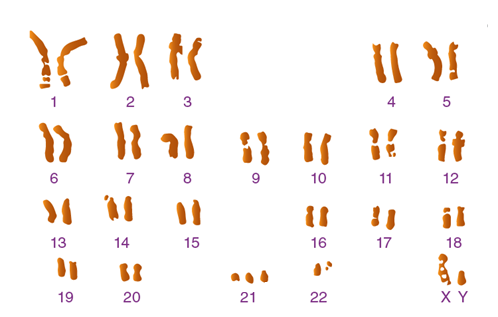 Sau khi quan sát bộ NST dưới tiêu bản hiển vi, một kỹ thuật viện tại phòng thí nghiệm di truyền y học mô tả về bộ NST của người ở ảnh bên. Hãy cho biết, kết luận nào là sai với mô tả của kỹ thuật viên này? (ảnh 1)