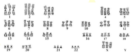 Một người phụ nữ 28 tuổi đến khám thai nhi được 15 tuần tuổi. Người này đã được chọc dò dịch ối và phát hiện ra trong tế bào thai nhi có 69 NST (ảnh 1)