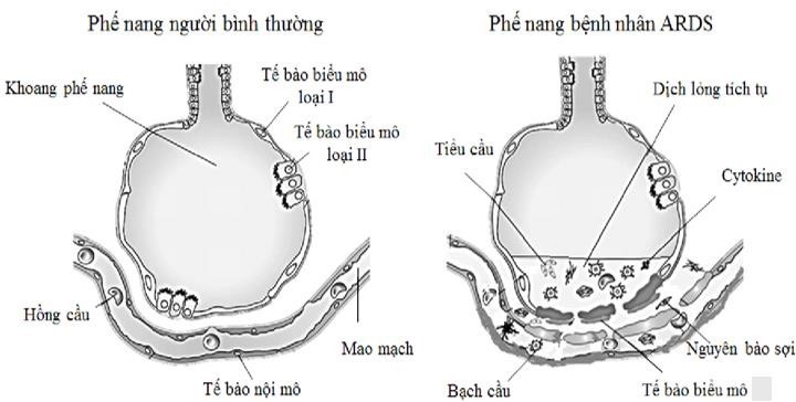 Virus nCoV là loại virus corona mới gây đại dịch toàn cầu. Một trong những triệu chứng trong giai đoạn diễn tiến nặng của nhiều bệnh nhân nhiễm virus này là hội chứng suy hô hấp cấp tiến triển ARDS  (ảnh 1)