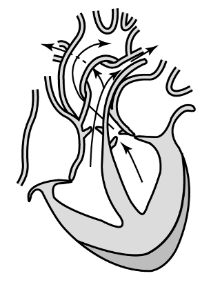 Hình 1 vẽ dưới đây thể hiện pha nào trong 1 chu kì tim?   Hình 1  A. Pha tâm thất co.	           B. Pha tâm nhĩ dãn.	       C. Pha tâm nhĩ co.	   D. Pha dãn chung (ảnh 1)