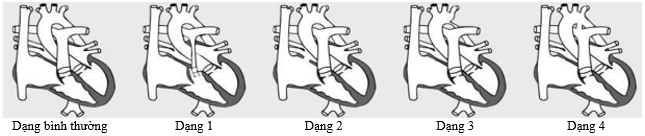 Hình dưới đây cho thấy mô hình của bốn dạng dị tật tim bẩm sinh thường gặp ở người: (ảnh 1)