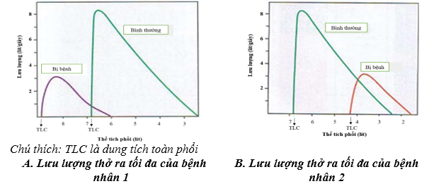 Hình A và B dưới đây mô tả đường biểu diễn thể tích - lưu lượng thở ra tối đa của hai bệnh nhân. Trong đó, một bệnh nhân mắc bệnh phổi tắc nghẽn (bệnh hô hấp gây khó thở vì đường thở bị hẹp lại so với bình thường) (ảnh 1)