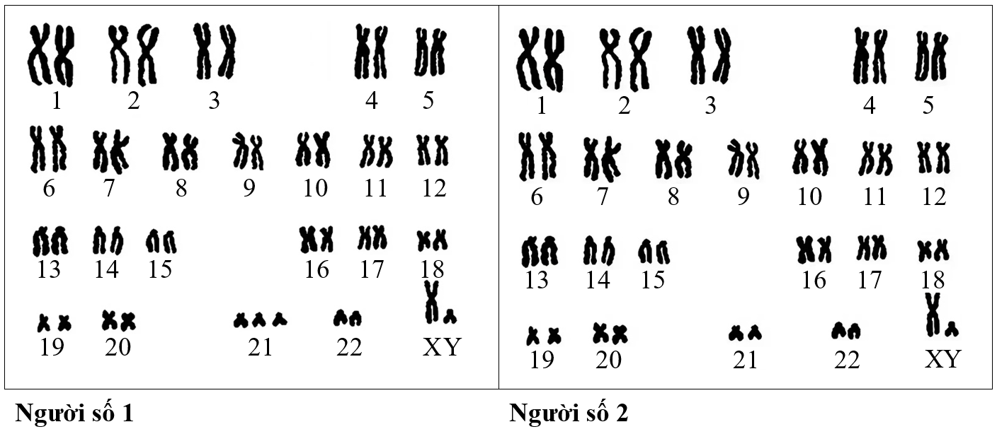 Để tìm hiểu về một hội chứng di truyền, người ta đã so sánh bộ nhiễm sắc thể của một người bình thường và một người mắc hội chứng (người số 1 và người số 2).  (ảnh 1)