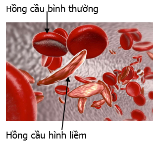 Ở người, bệnh hồng cầu h&igrave;nh liềm HbS l&agrave;m biến đổi hồng cầu từ dạng h&igrave;nh đĩa l&otilde;m hai mặt th&agrave;nh dạng h&igrave;nh lưỡi liềm dẫn đến xuất hiện h&agrave;ng loạt bệnh l&iacute; trong cơ thế. Bệnh do đột biến điểm ở gene quy định chuỗi &beta; Hemoglobin (ảnh 1)