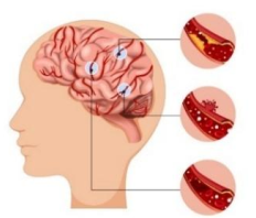 Tai biến mạch máu não hay còn gọi là đột quỵ, xảy ra khi nguồn máu cung cấp cho não bị tắc nghẽn. Đây được xem là một trong những bệnh lý nguy hiểm nhất, nguy cơ tử vong cao nếu không sớm nhận biết triệu chứng tai biến (ảnh 1)