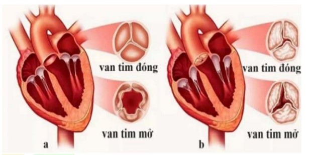 Hình 1 mô tả hoạt động của hệ thống van tim ở  hai cơ thể động vật (a và b). Nhận xét nào sau đây đúng?  A. a bị bệnh về van tim, b bình thường.  B. a bình thường, b bị bệnh về van tim.  C. cả a và b đều bị bệnh về van tim.  D. cả a và b đều bình thường. (ảnh 1)