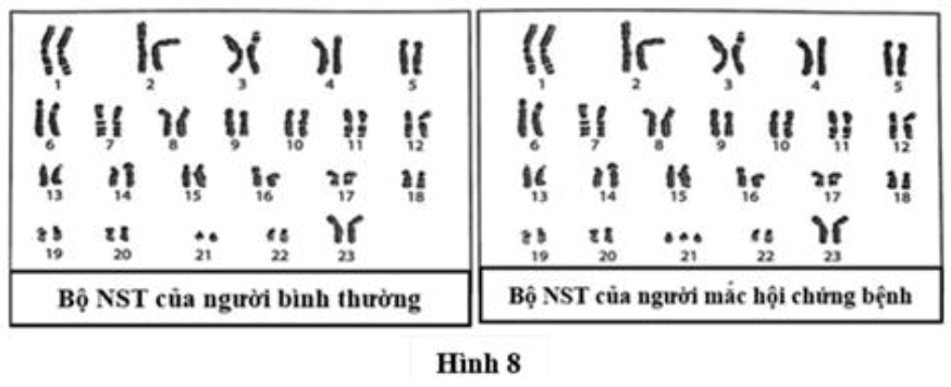 Hình 8 mô tả bộ nhiễm sắc thể của người bình thường và người bị hội chứng bệnh. Phân tích hình này và cho biết mỗi nhận định sau đây Đúng hay Sai? (ảnh 1)