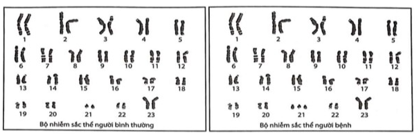 Hình vẽ dưới đây mô tả bộ nhiễm sắc thể của người bình thường và người bị bệnh.     Cơ chế gây ra bệnh này là sự kết hợp giữa giao tử bình thường với giao tử có bao nhiêu NST? (ảnh 1)