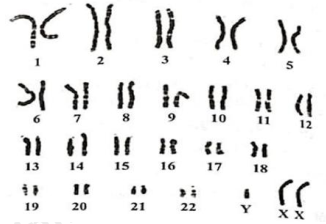 Hình bên mô tả nhiễm sắc thể của một tế bào ở người mắc hội chứng Klinefelter. Số lượng NST trong tế bào sinh dưỡng của người này là bao nhiêu? (ảnh 1)