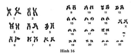 Dưới đây là hình ảnh mô tả bộ nhiễm sắc thể trong tế bào sinh dưỡng ở một người mắc một hội chứng lệch bội. (ảnh 1)