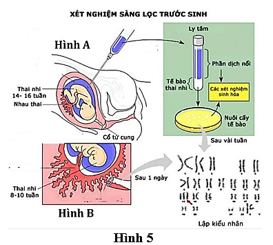 Hình 5 mô tả về các biện pháp sàng lọc trước sinh ở người.    Nhận định nào sau đây là sai? (ảnh 1)