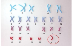 Quan sát bộ nhiễm sắc thể người bị bệnh ở hình dưới đây và cho biết người này bị hội chứng bệnh gì?   	A. Hội chứng Down. 			B. Hội chứng Turner. 	C. Hội chứng tiếng mèo kêu. 	D. Hội chứng Klinefelter. (ảnh 1)