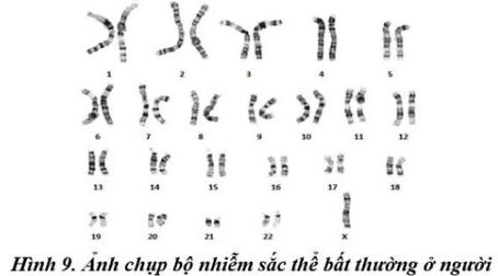 Quan sát Hình 9, hãy cho biết người có bộ NST bất thường này mắc hội chứng gì? (ảnh 1)