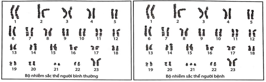 Hình 8 mô tả bộ nhiễm sắc thể của người bình thường và người bị bệnh. Có bao nhiêu nhận định đúng về bệnh này? (ảnh 1)