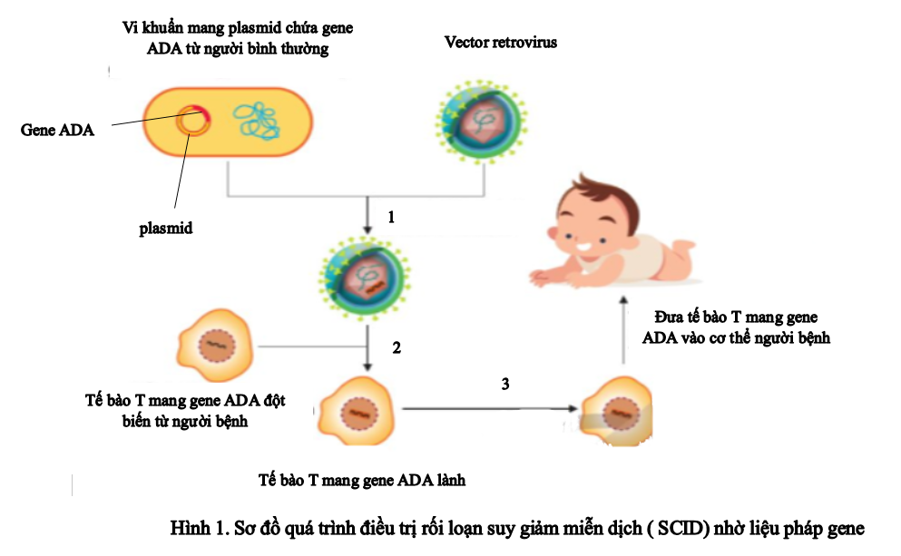 Hình 1 mô tả sơ đồ quá trình điều trị rối loạn suy giảm miễn dịch ( SCID) nhờ liệu pháp gene. Nội dung nào sau đây đúng cho các bước được đánh số 1, 2 và 3 trong hình ? (ảnh 1)