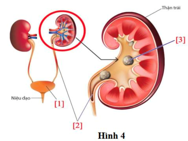 Hình 4 mô tả thận, bệnh sỏi thận và đường tiết niệu như sau: (ảnh 1)