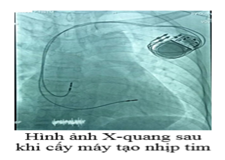 Bộ phận quan trọng nhất của máy tạo nhịp tim là một hệ pin điện hóa lithium – iodine (ảnh 1)