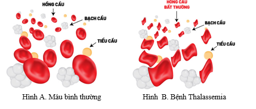 Thalassemia (tan máu bẩm sinh) là một bệnh di truyền có tỷ lệ cao nhất trên Thế giới. Người bệnh thể nặng sẽ phải sống phụ thuộc vào truyền máu và có thể phải chịu những biến chứng nặng nề như: (ảnh 1)