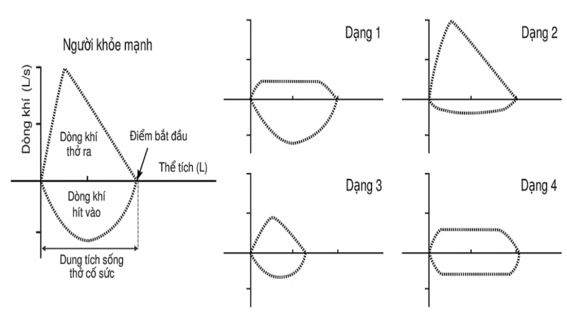 Hình 7 cho thấy dạng của vòng lưu lượng-thể tích phổi đo được khi hít vào cố sức và thở ra cố sức ở người khỏe mạnh với chức năng hô hấp bình thường và bốn bệnh nhân bị các rối loạn hô hấp thường gặp. (ảnh 1)